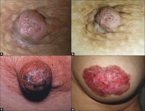 (a and b) Paget's disease of the nipple. The clinical appearance is usually a thickened,