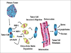 Multistep metastatic process of prostate cancer cells