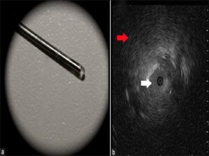An ultra-miniature radial-endobronchial ultrasound (UM-EBUS) endobronchial