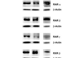 Role of retinoic acid receptors in squamous-cell carcinoma in human esophagus Bergheim I, Wolfgarten E, Bollschweiler E, Holscher A H, Bode Ch, Parlesak A