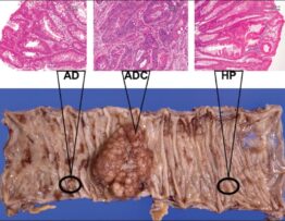 Colorectal carcinogenesis: Review of human and experimental animal studies